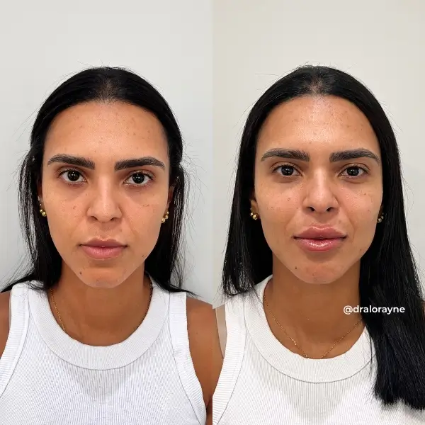 Resultado de realce facial natural
