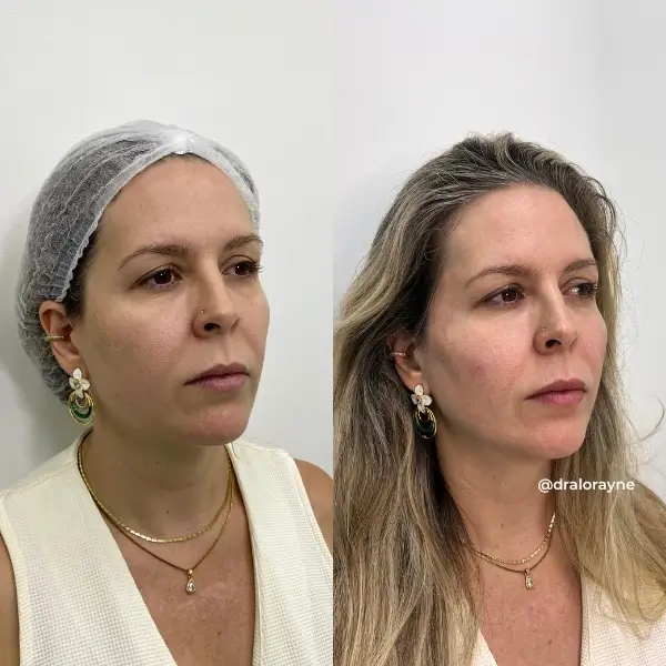 Resultado de realce facial natural