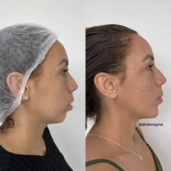 Resultado de realce facial natural
