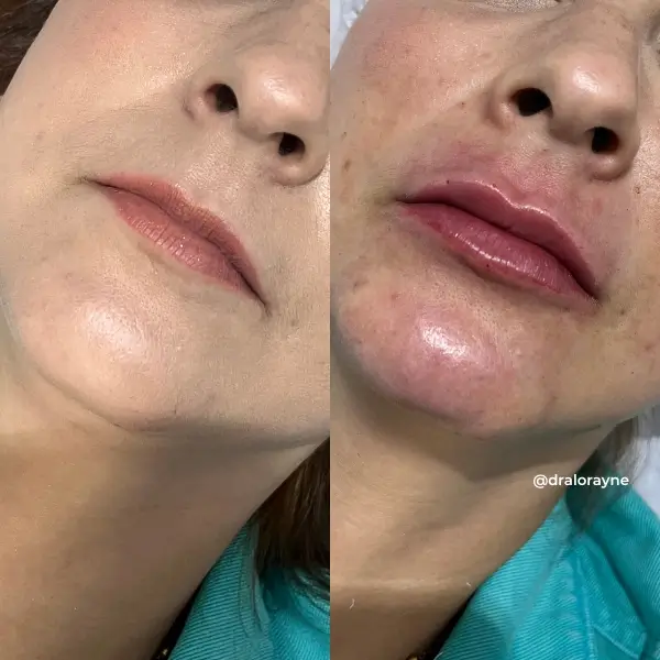 Resultado de realce facial natural