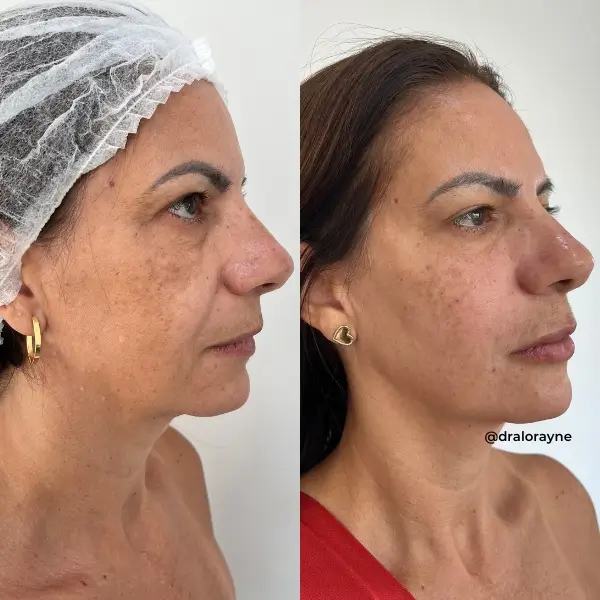 Resultado de realce facial natural