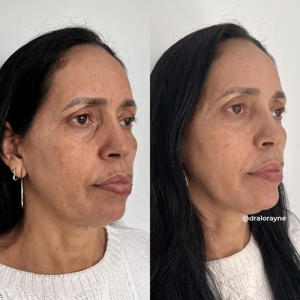 Resultado de realce facial natural
